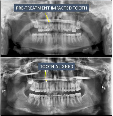 xray of impacted tooth